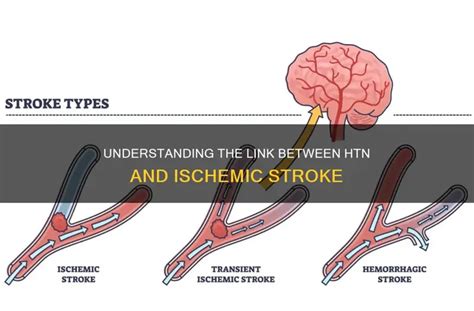 understanding  link  htn  ischemic stroke medshun