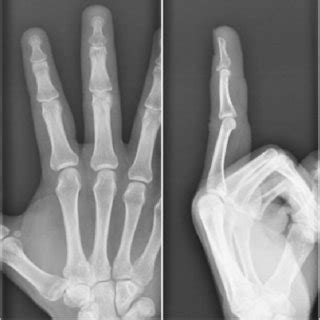 Post Operative Antero Posterior And Lateral Radiographs Showing In Situ