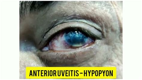 Anterior Uveitis With Hypopyon Youtube