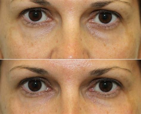 Under Eye Filler Nyc Cannula Eye Lift Dr Brett Kotlus