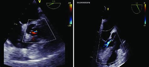 Post Repair Mid Esophageal Aortic Valve Short Axis View Showing Normal