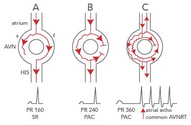 Av Nodal Reentrant Tachycardia