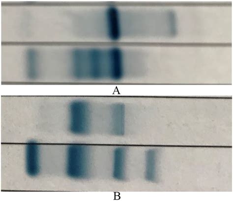 Agarose Gel Electrophoresis Shows A Faster Move Band Hb H Band On The