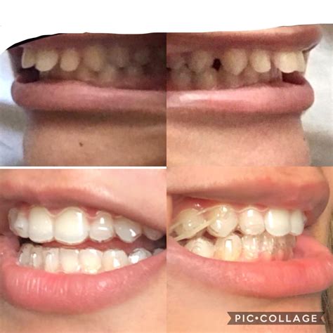 Invisalign Before And After Overjet