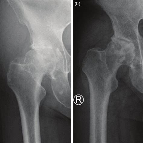 3 Preoperative Anteroposterior X Ray Of The Right Hip Joints Of Two Download Scientific Diagram