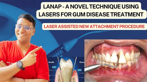 Dr Rudra Mohan Laser Assisted New Attachment Procedure Lanap