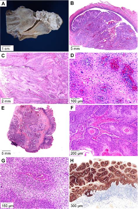 Warty And Warty Basaloid Squamous Cell Carcinoma Human Download