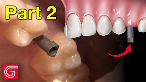 HOW TO Place A Scan Body Implant For A Screw Retained Crown YouTube