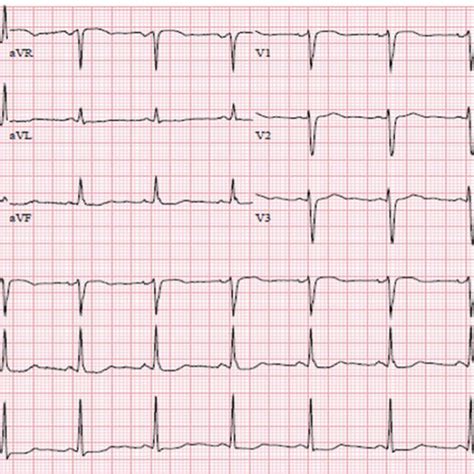 Resting Electrocardiogram On Admission Showing Normal Sinus Rhythm