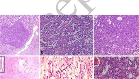 Histologic Features Of Ah Low Power Showed A Well Delineated Lesion