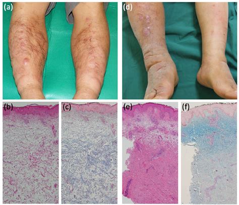 Figure 1 From Pretibial Myxedema Exhibiting Prominent Asymmetrical Manifestations Semantic Scholar