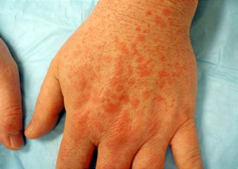 Erythema Multiforme Target Lesions