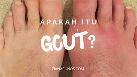 Penyakit Gout Punca Tanda Tanda Dan Set Gout Shaklee Ziana Eunos