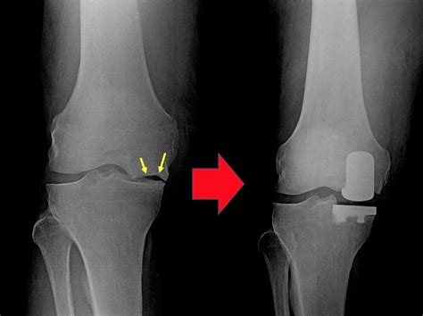 Partial Unicondylar Knee Replacement Orthoist