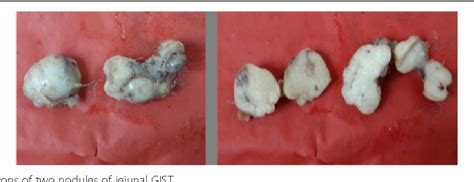 A Rare Combination Of Pheochromocytoma And Gastrointestinal Stromal Tumour In A Patient With