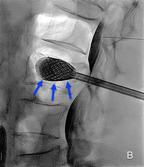 Vertebroplasty for vertebral body fracture Universitätsinstitut für