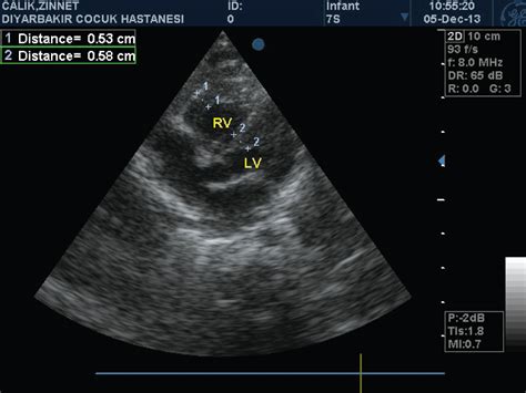 Clinmed International Library Transient Isolated Right Ventricular