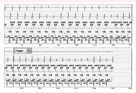 Figure 1 from Rapid atrial pacing above the maximum sensor rate: a case report | Semantic Scholar