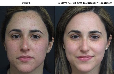 Before and After IPL/ResurFX - Central Florida Dermatology Associates