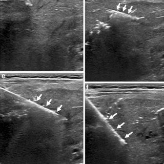 Percutaneous Core Needle Biopsy In An Month Old Boy With Newly