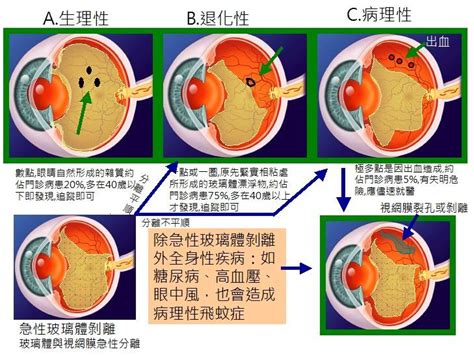 飞蚊症图片 6有来医生