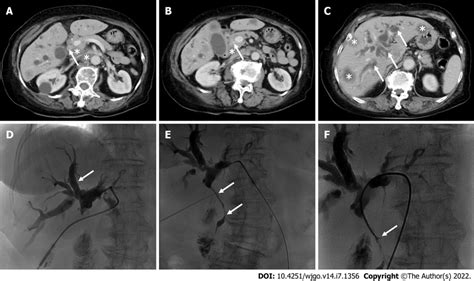 Contrast Enhanced Computed Tomography And Percutaneous Transhepatic