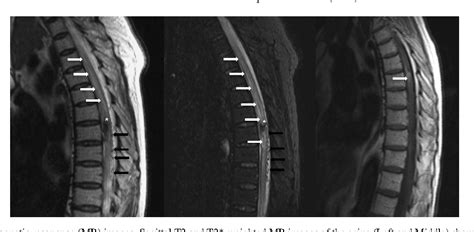 Figure 3 From Intramedullary Hemorrhage From A Thoracolumbar Dural