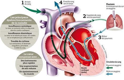 Insuffisance Cardiaque Qu Est Ce Que C Est Fiches Sant Et