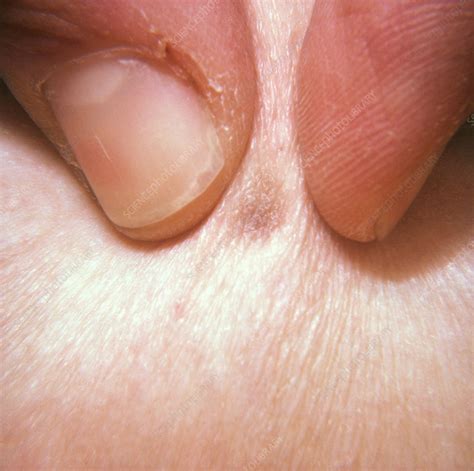 Dermatofibroma Dimple Sign