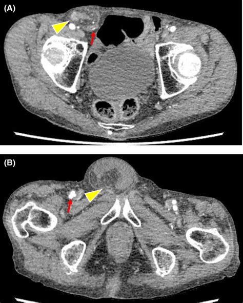 A Case Of Bilateral Concomitant Inguinal And Femoral Hernias Treated