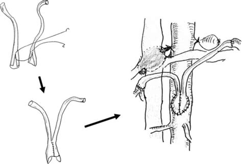 Scheme Of Bilateral Renal Artery Bypass Grafting Using Autologous