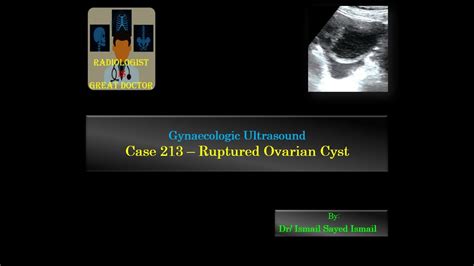 Ruptured Ovarian Cyst