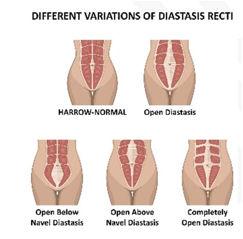 Diastasis Recti Rad Specialists In General Surgery Sgs