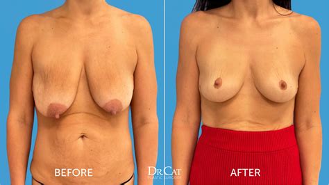 Breast Lift Recovery Guide Week By Week Timeline Dr Cat Begovic