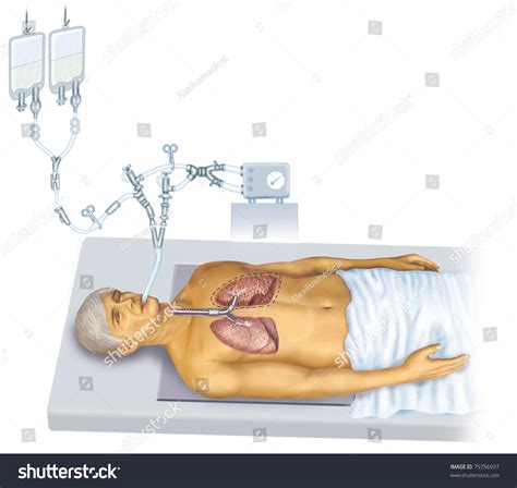 10 Bronchoalveolar lavage Images, Stock Photos & Vectors | Shutterstock