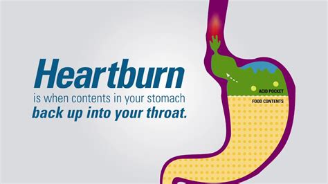 Heartburn What Is Causes Treatment Complications And Symptoms