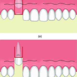 Pdf Flap Techniques In Dentoalveolar Surgery