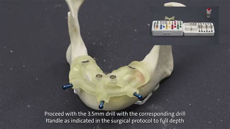 Straumann® Guided Surgery System And Straumann® Blt Youtube