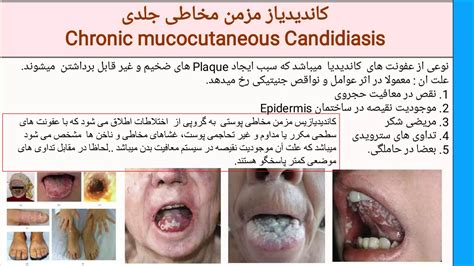 5 Chronic Mucocutaneous Candidiasispptx Free Download