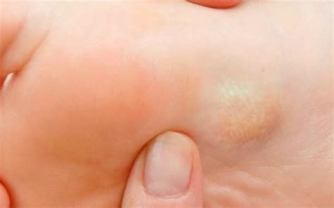 Small Hard Bumps On Bottom Of Foot Store Emergencydentistry