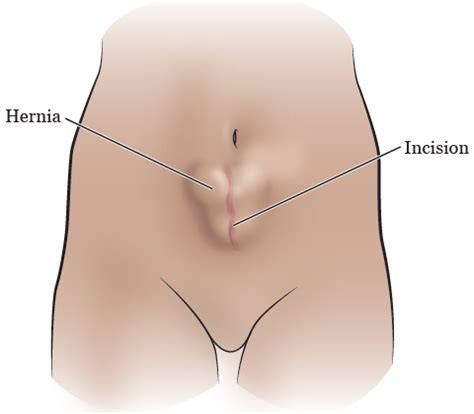 Todo Lo Que Necesitas Saber Sobre La Hernia Post Ces Rea S Ntomas