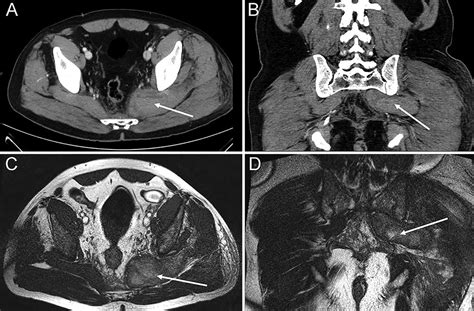 Piriformis Muscle Mri