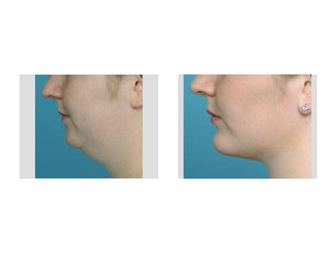 Recovery after Neck Liposuction - Explore Plastic Surgery