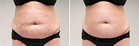 Stretch Marks Scar Reduction Services Unique Bca