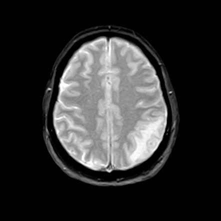 Neurocysticercosis Solitary Image Radiopaedia Org