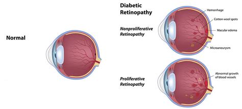 Diabetic Eye Care Specialists Ocli Vision