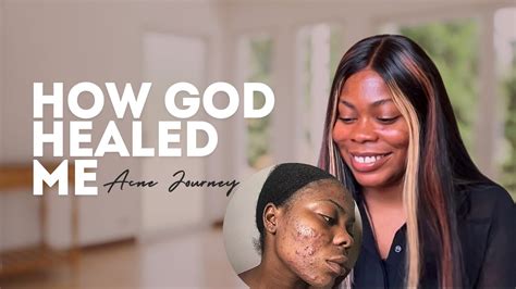 How God Healed Me My Acne Journey Before And After Youtube