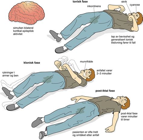 Status Epilepticus Store Medisinske Leksikon