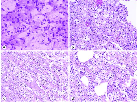 Pathology Hematoxylin And Eosin Stains A Cytologic Preparation