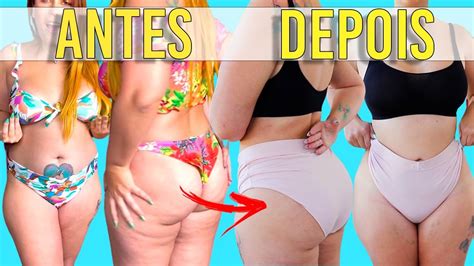 ANTES E DEPOIS DE COLOCAR GORDURA NO QUADRIL ENXERTO DE GORDURA YouTube